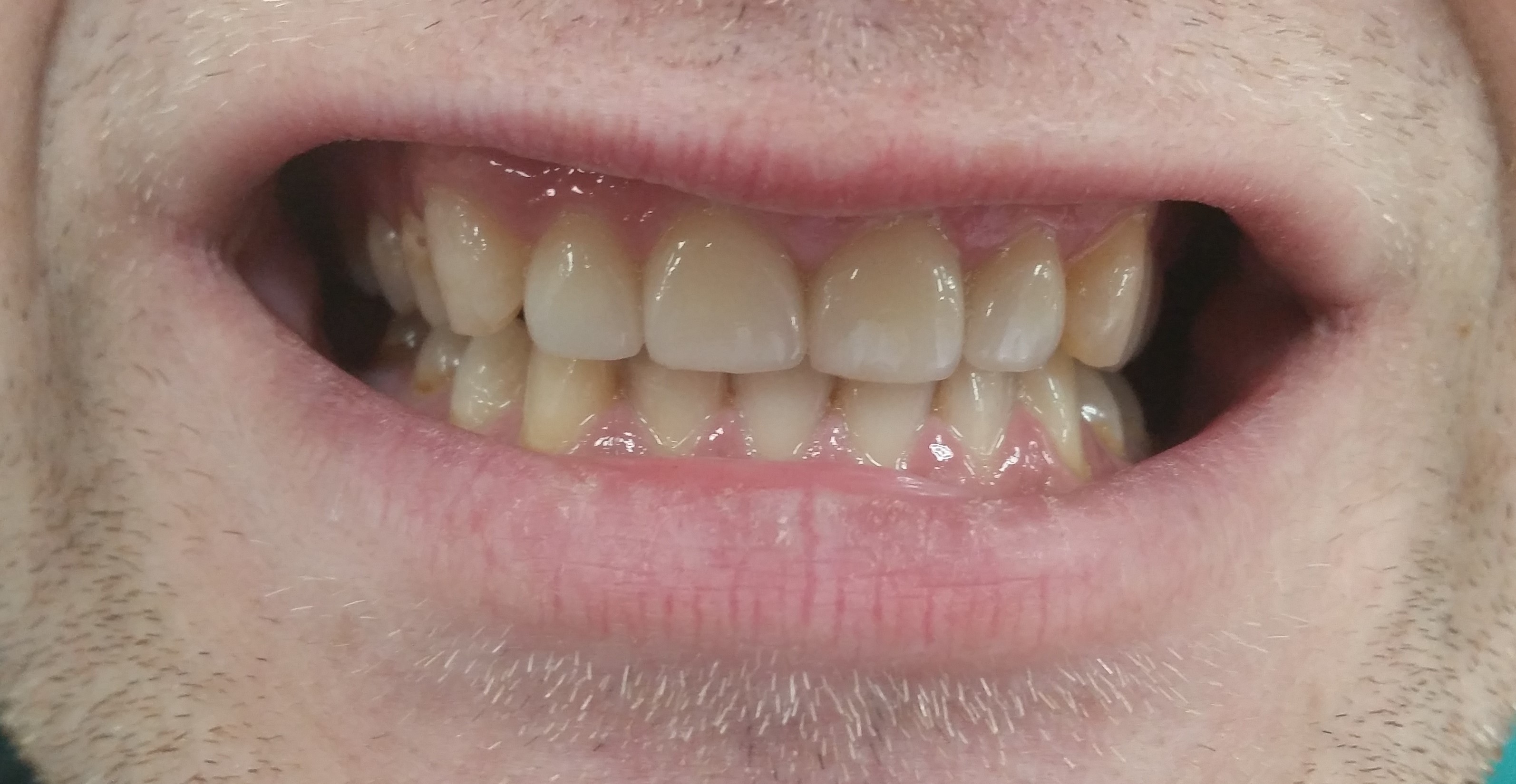 4 верхних центральных зуба-установлены коронки и виниры емах. зубы "живые" ( не депульпированы)